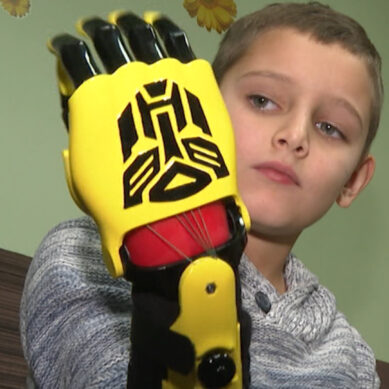 Дети из Калининграда бесплатно получат инновационные протезы из Сколково